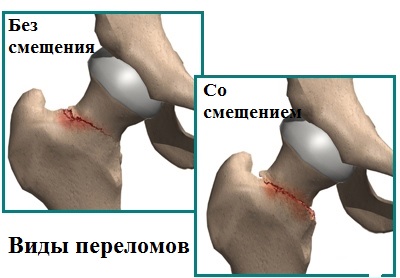 Реферат: Перелом шейки бедра